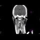 Small epidural hematoma: CT - Computed tomography